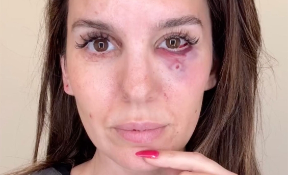 CHRISTY CARLSON ROMANO SURVIVES TERRIFYING SHOOTING ACCIDENT: 'I SAW MY LIFE FLASH BEFORE MY EYES'