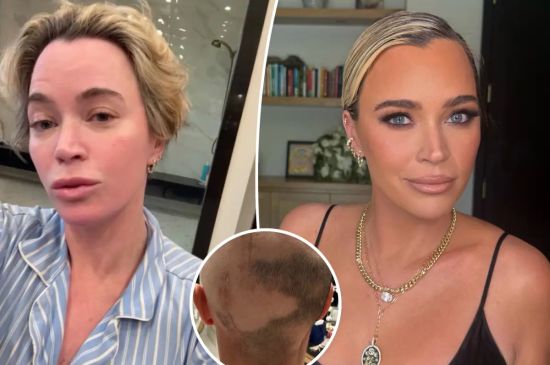 TEDDI MELLENCAMP SHOWS SURGERY SCARS AND ASKS FANS FOR HAIR ADVICE DURING CANCER TREATMENT 